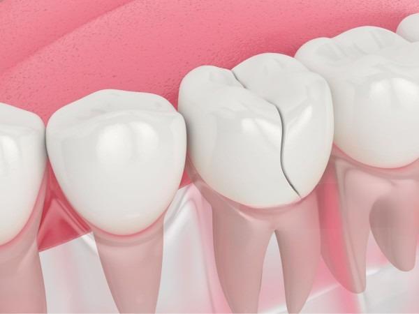 Giấc mơ thấy gãy răng và lời nhắn gửi từ tâm linh