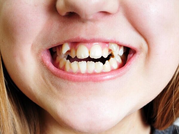 Phân tích bí ẩn mơ thấy gãy răng qua từng tình huống