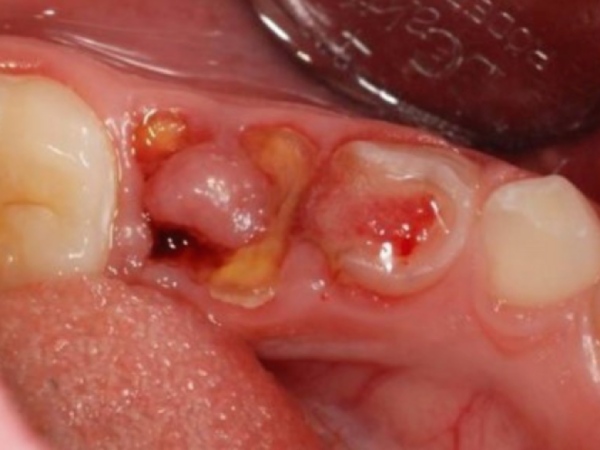 Nằm mơ thấy gãy răng chảy máu là điềm gì, đen hay đỏ?