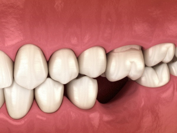 Nằm mơ thấy gãy răng hàm dưới là điềm gì, tốt hay xấu?